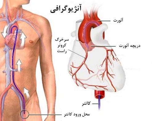 راهنمای بیمار آنژیوگرافی